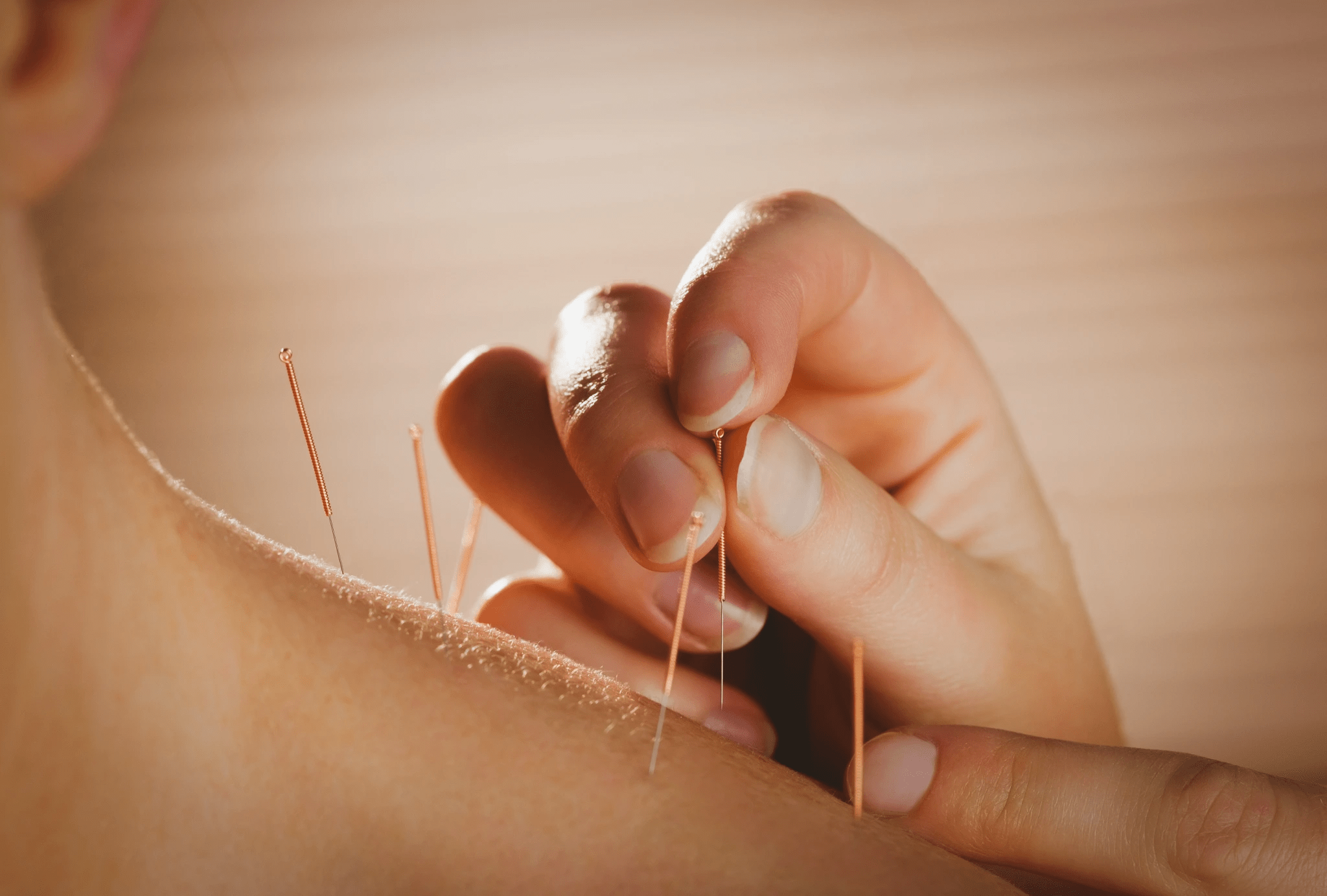 Acupuncturist performing pain-relief treatment in Fort Collins clinic